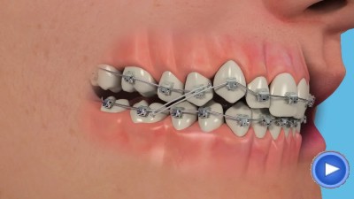 Elastics Bee Happy Orthodontics