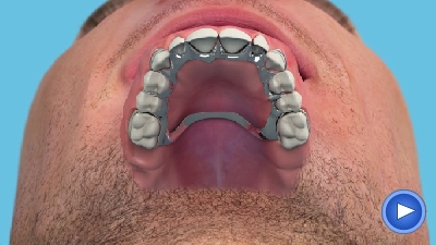 Denture Reline Cost Uk  : While The Cost Of Any Dental Procedure Can Vary Relines, A Repositioning Of The Denture, Costs Around $600 If It Can Be Done In Office And Around.