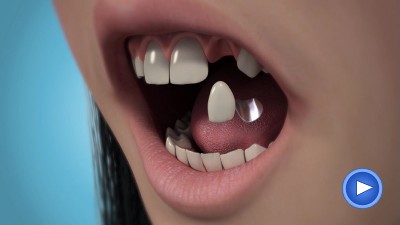 Sostituire i denti mancanti